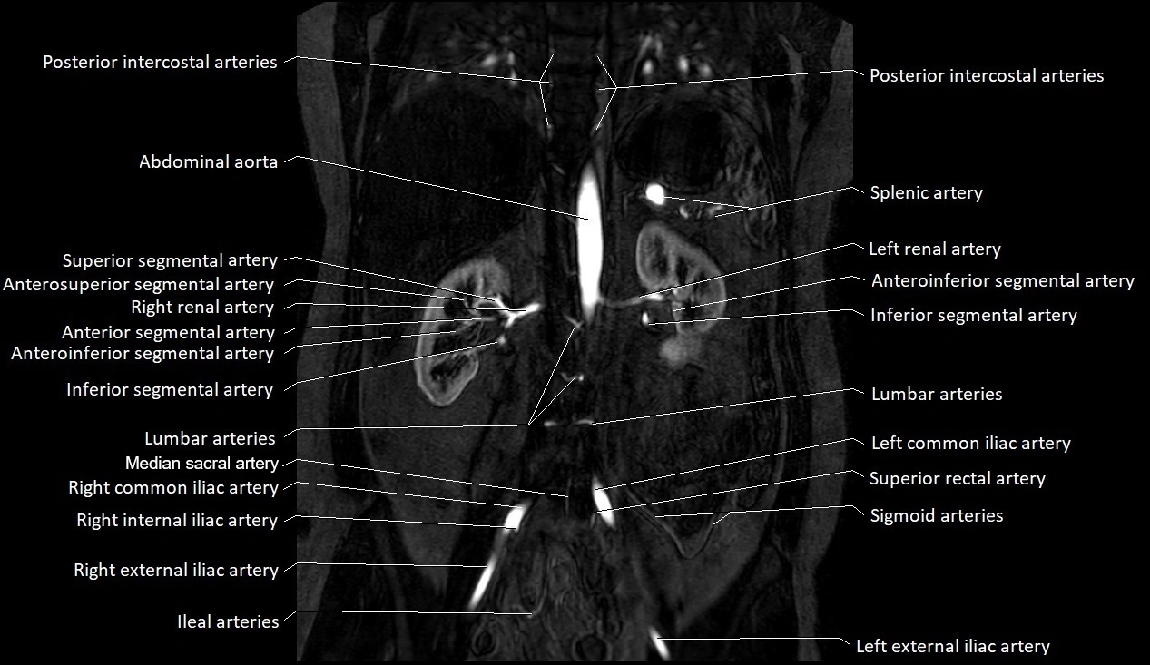 MRA Abdomen coronal anatomy image 27.webp